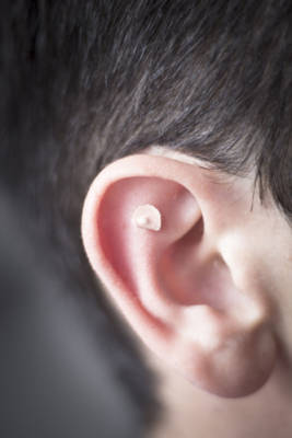 ear receiving auricular acupuncture